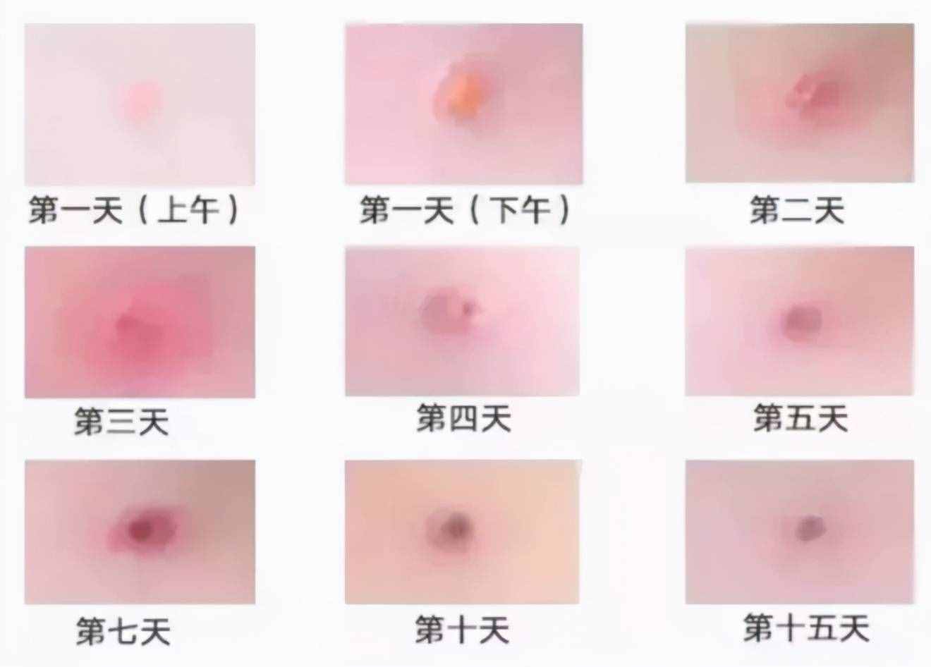 春季水痘爆发！22名学生确诊！娃出现这种情况，赶紧隔离