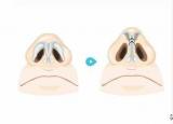 今日更新缩小鼻翼的方法（鼻翼缩小术三种常见方法）