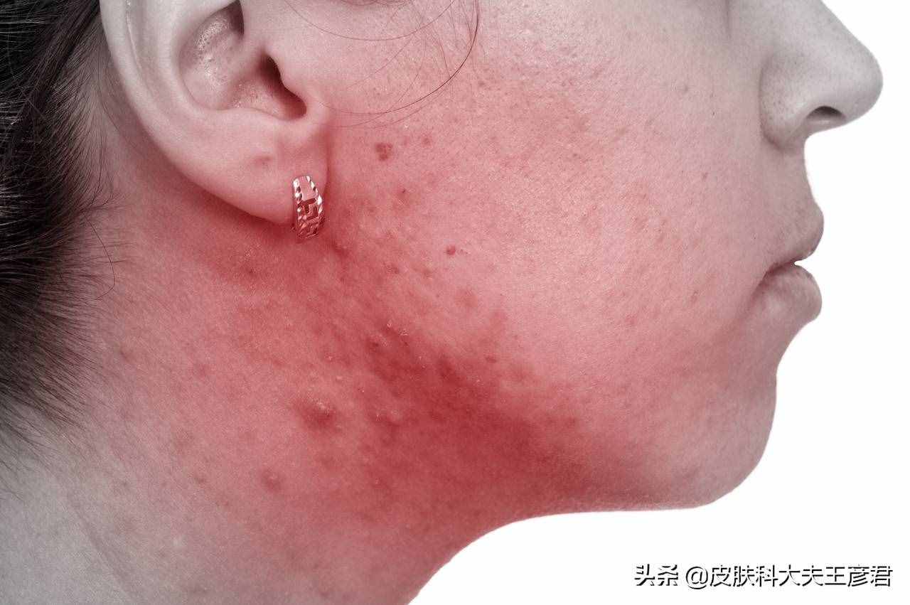 脸上痘痘变硬的原因及其解决方案