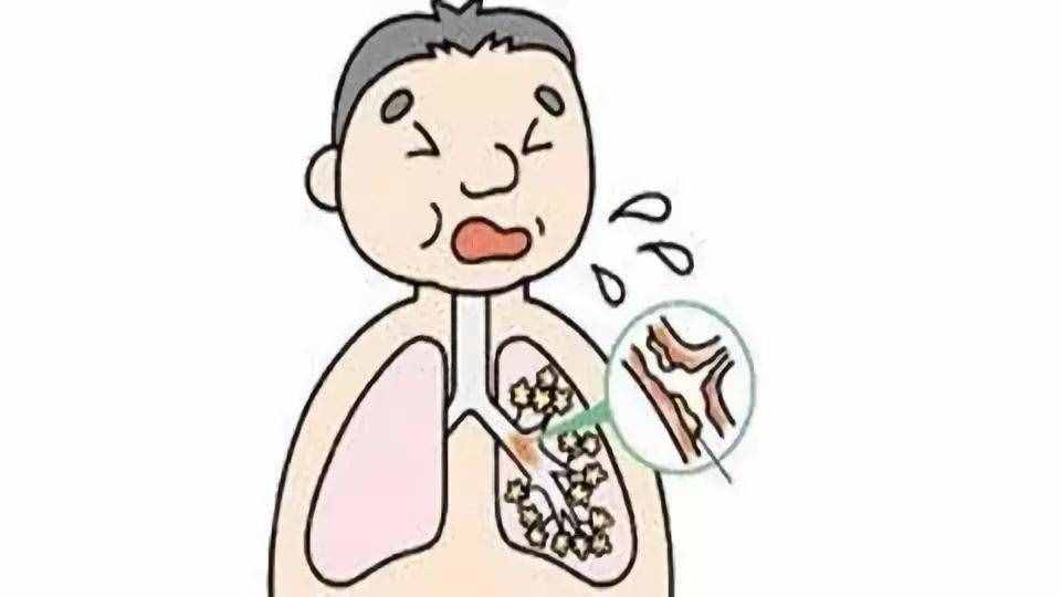 老年人肺炎的诊断与治疗