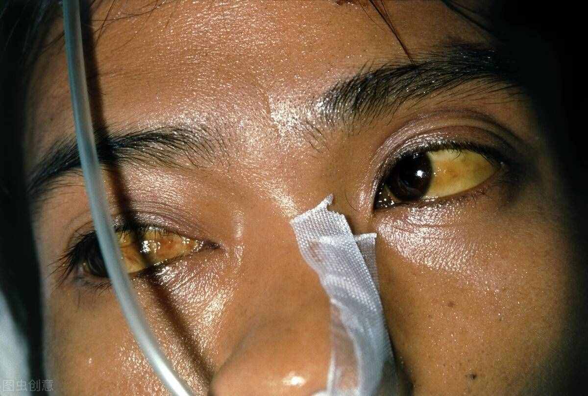 肝癌死亡率达70％，知道肝癌的八个征兆 早发现早治疗