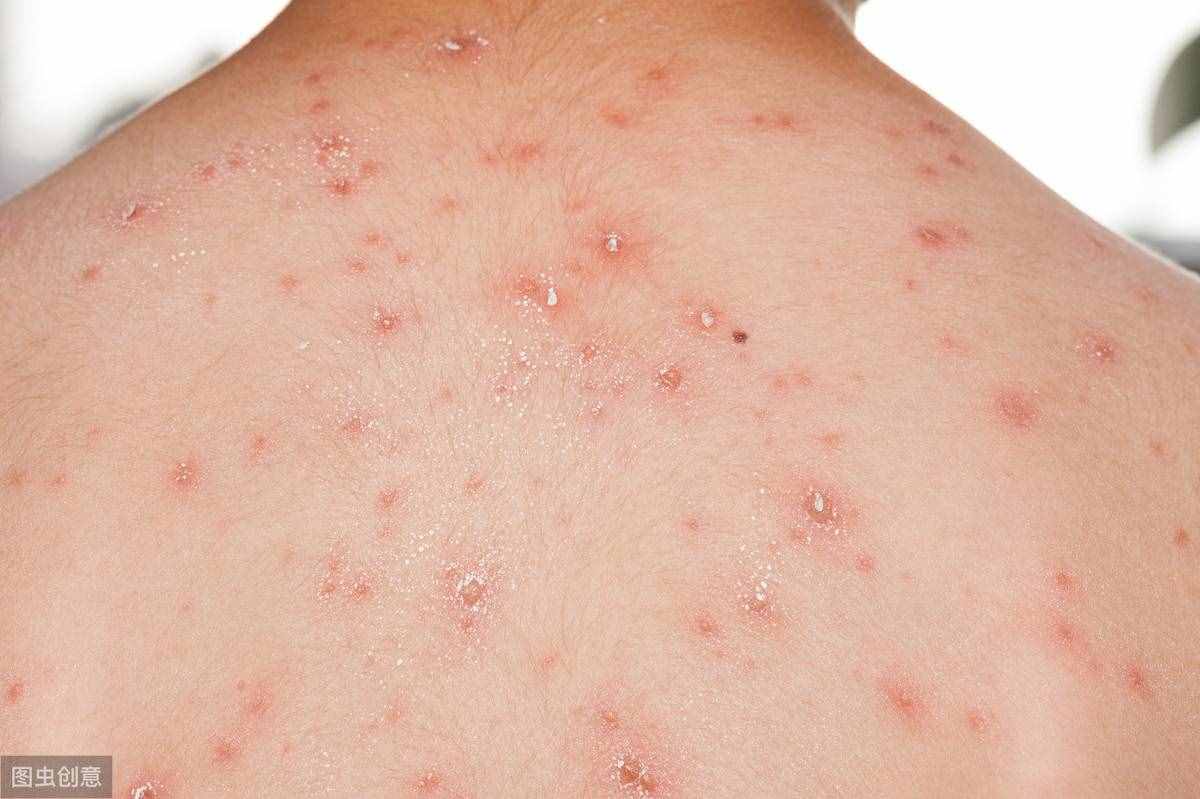 “四世同堂”的水痘该如何护理？能用肥皂洗澡吗？要不要了解一下