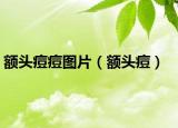 额头痘痘图片（额头痘）