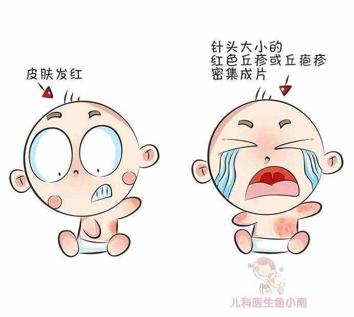 宝宝皮疹、湿疹、热疹，傻傻分不清？医生：用错药，小心越治越糟