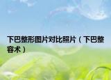 下巴整形图片对比照片（下巴整容术）