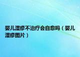 婴儿湿疹不治疗会自愈吗（婴儿湿疹图片）