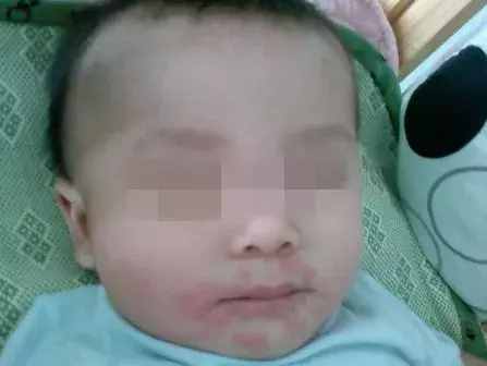 宝宝过敏怎么办？教你几个妙招，让宝宝不再遭罪！