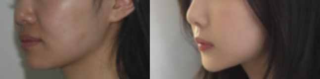 方脸型怎么瘦成瓜子脸？