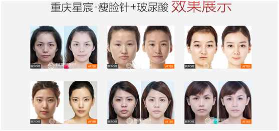 瘦脸针多少钱一次？