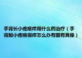 手背长小疙瘩痒用什么药治疗（手背起小疙瘩很痒怎么办有图有真像）