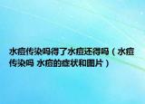 水痘传染吗得了水痘还得吗（水痘传染吗 水痘的症状和图片）