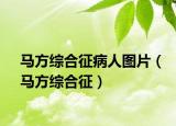 马方综合征病人图片（马方综合征）