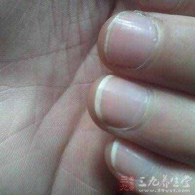 指甲上出现白点暗示健康亮“红灯”