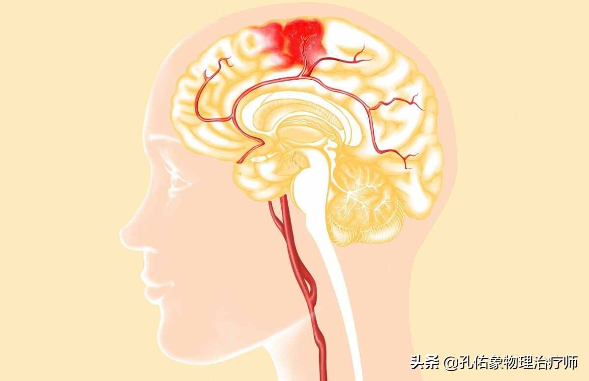 为何如此多的人发生脑出血？要如何正确应对？一文详细告知您