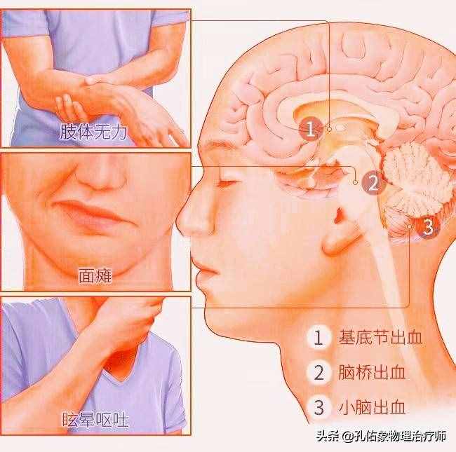 为何如此多的人发生脑出血？要如何正确应对？一文详细告知您