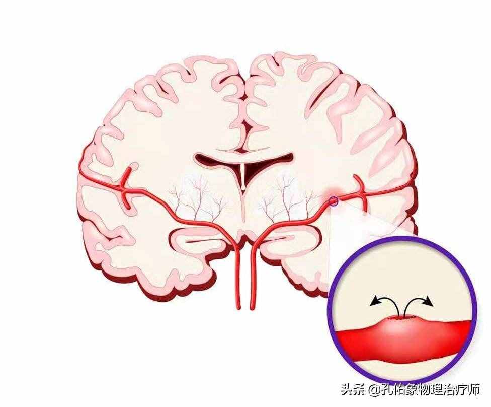 为何如此多的人发生脑出血？要如何正确应对？一文详细告知您