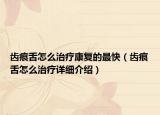 齿痕舌怎么治疗康复的最快（齿痕舌怎么治疗详细介绍）