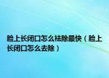 脸上长闭口怎么祛除最快（脸上长闭口怎么去除）