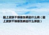 腿上皮肤干燥像鱼鳞是什么病（腿上皮肤干燥像鱼鳞是什么原因）