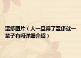 湿疹图片（人一旦得了湿疹就一辈子有吗详细介绍）