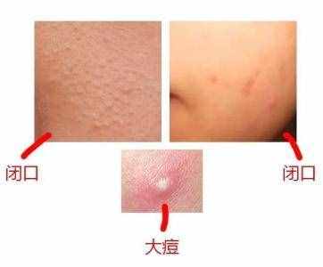 粉刺是什麽，怎麼消除