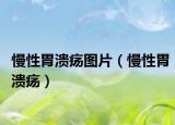 慢性胃溃疡图片（慢性胃溃疡）