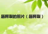 唇腭裂的照片（唇腭裂）