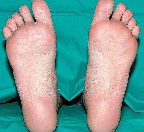 常见的几种足底疼痛，哪些原因引起的呢？