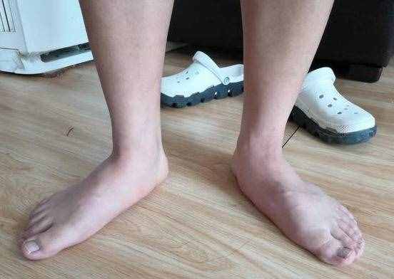 常见的几种足底疼痛，哪些原因引起的呢？
