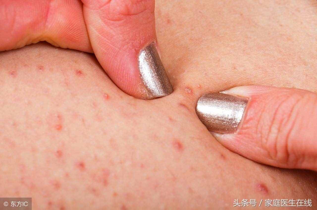 患上毛囊炎该怎么办？这些方法，是过来人的经验