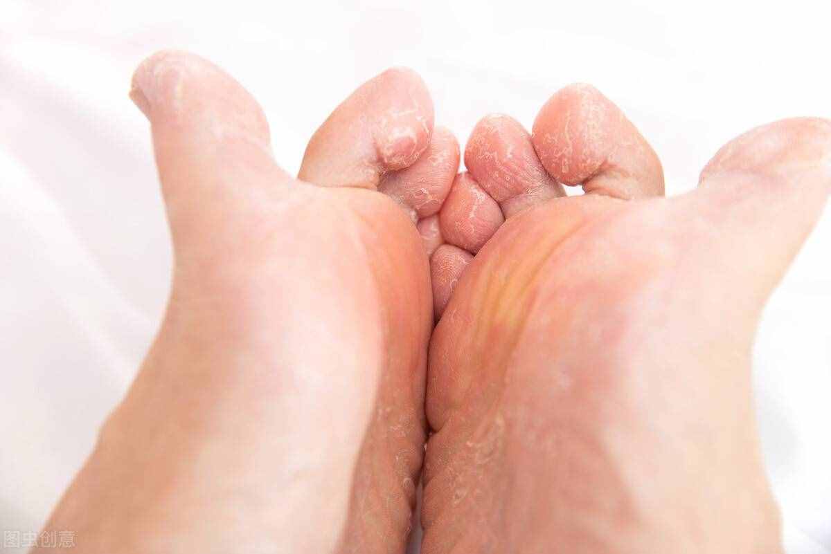 脚气，如何根除？医生教你4个小方法，简单有效祛脚气