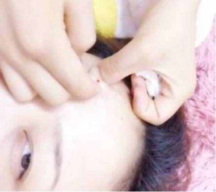 学生怎么祛痘痘？每天5毛钱让你轻松祛痘不留痕