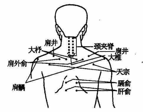 拔火罐能治疗颈椎病，为家人收藏起来！