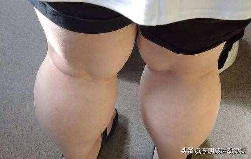 如何瘦小腿？原因和练习方案