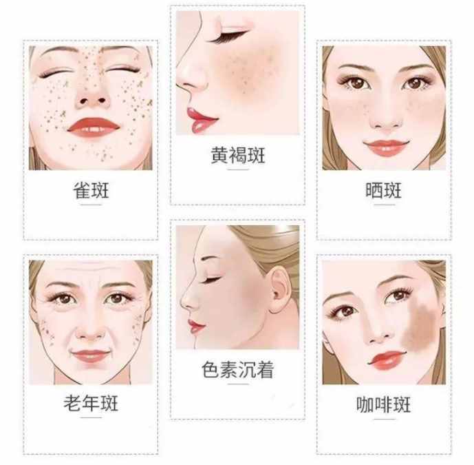 脸上的斑，有什么方法去除？别踩雷了，真正有效祛斑的方法都在这