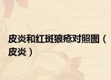 皮炎和红斑狼疮对照图（皮炎）
