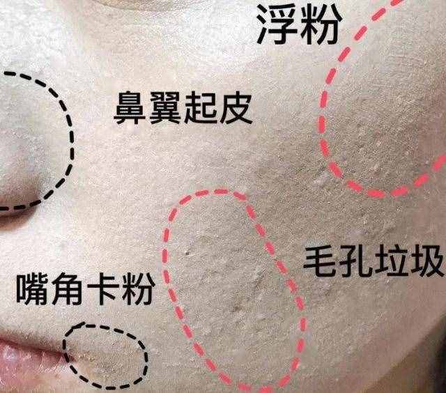 什么是闭口粉刺？为什么会长闭口？如何有效去闭口