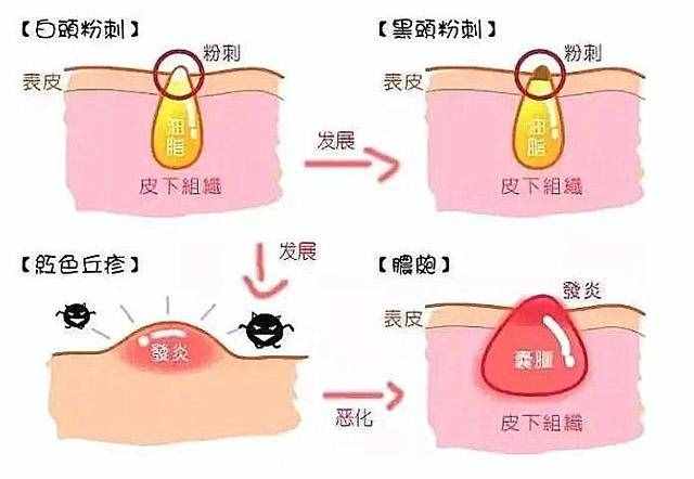 什么是闭口粉刺？为什么会长闭口？如何有效去闭口
