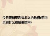今日更新甲沟炎怎么治除根(甲沟炎到什么程度要拔甲)