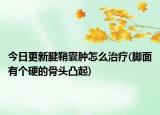 今日更新腱鞘囊肿怎么治疗(脚面有个硬的骨头凸起)
