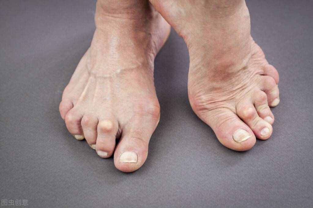 类风湿病怎么治疗才会好？一经确诊应尽早治疗才好