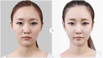 带你了解光子嫩肤