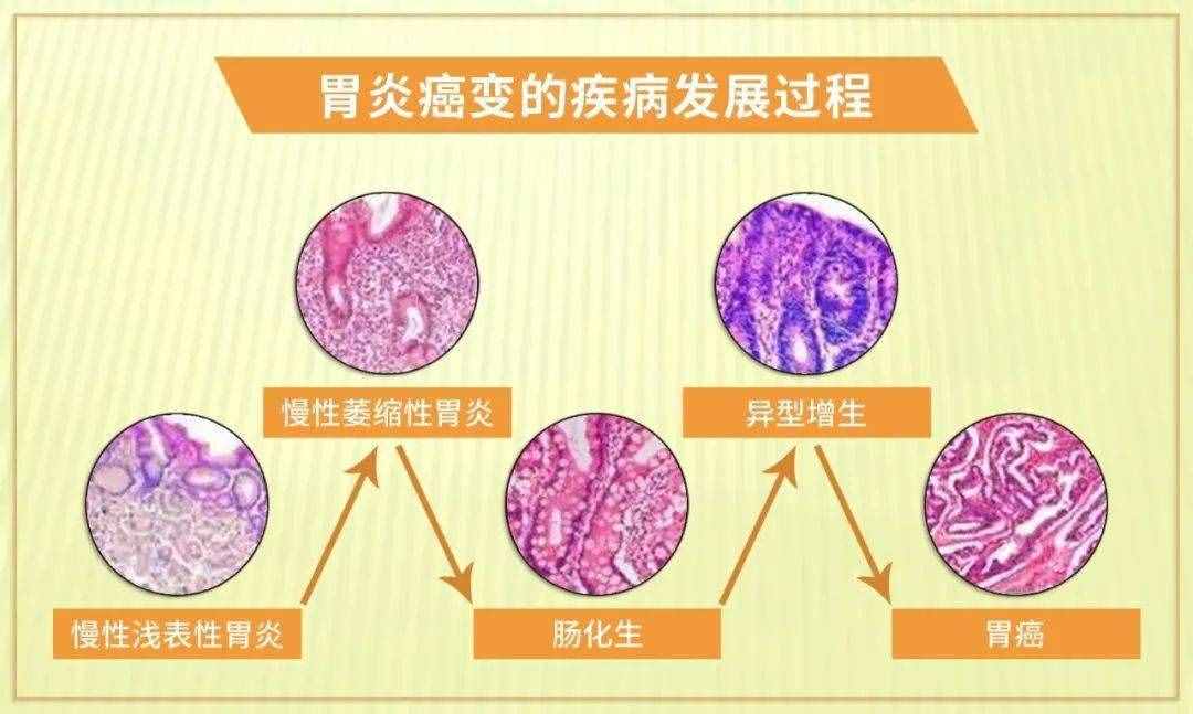 胃病都有哪些，什么症状
