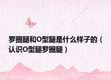 罗圈腿和O型腿是什么样子的（认识O型腿罗圈腿）