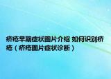 疥疮早期症状图片介绍 如何识别疥疮（疥疮图片症状诊断）