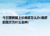 今日更新腿上长疱疹怎么办(疱疹的地方为什么会肿)
