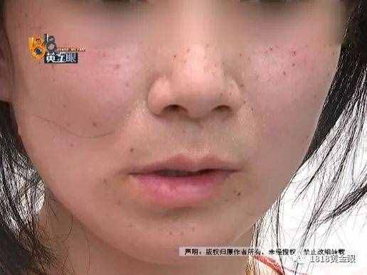 女子去点痣，一颗痣80元，点了110颗！老公怒了，结果……