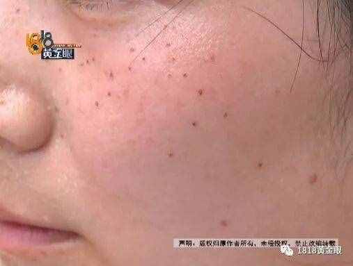 女子去点痣，一颗痣80元，点了110颗！老公怒了，结果……