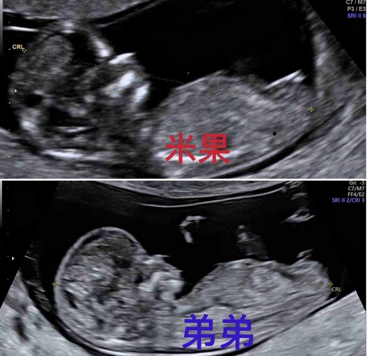罗志祥43岁经纪人小霜宣布怀二胎，仍是试管婴儿，孩子父亲不详