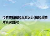 今日更新脚脱皮怎么办(脚脱皮图片真实图片)